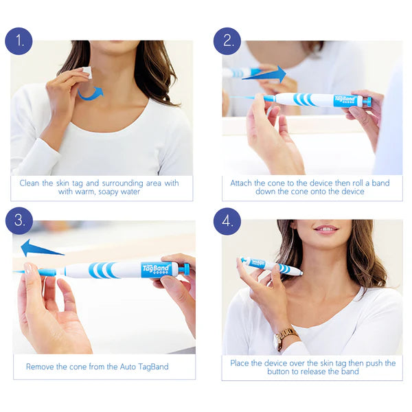 Painless Mole Wart Remover