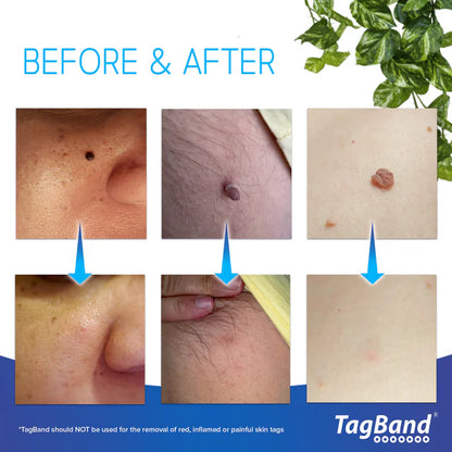 Painless Mole Wart Remover